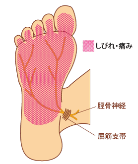 足先がピリピリ きつい靴 ストア