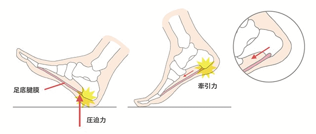 足底腱膜炎の原因