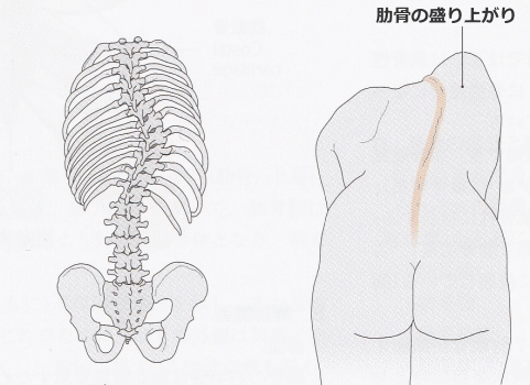 体が歪む側弯症