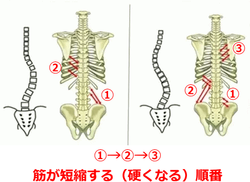 側弯症になるメカニズム