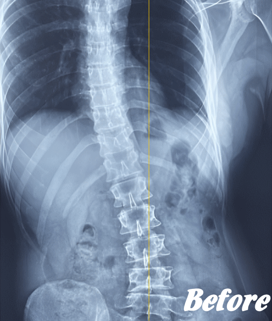 施術前の側弯の状態