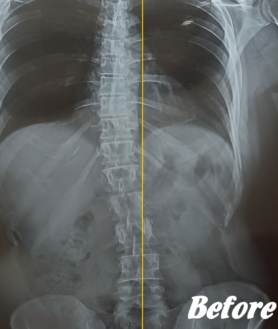 施術前の側弯の状態