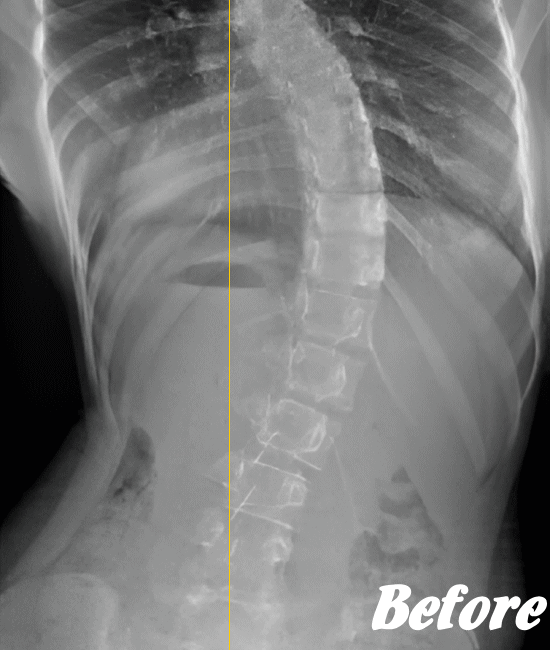施術前の側弯の状態