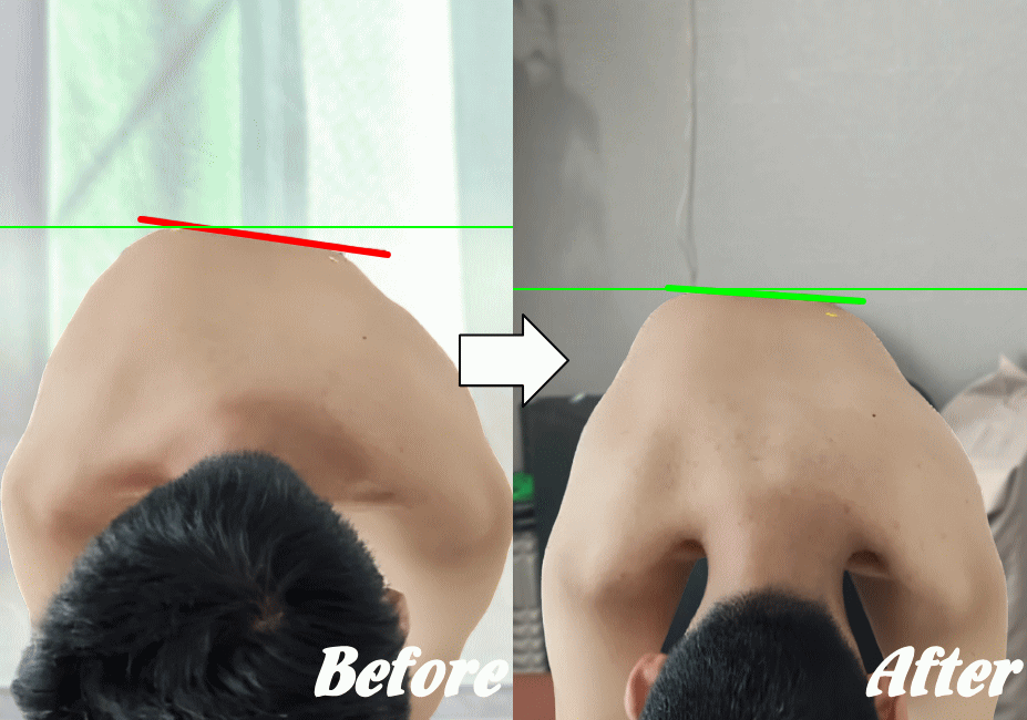 側弯施術のビフォー&アフター