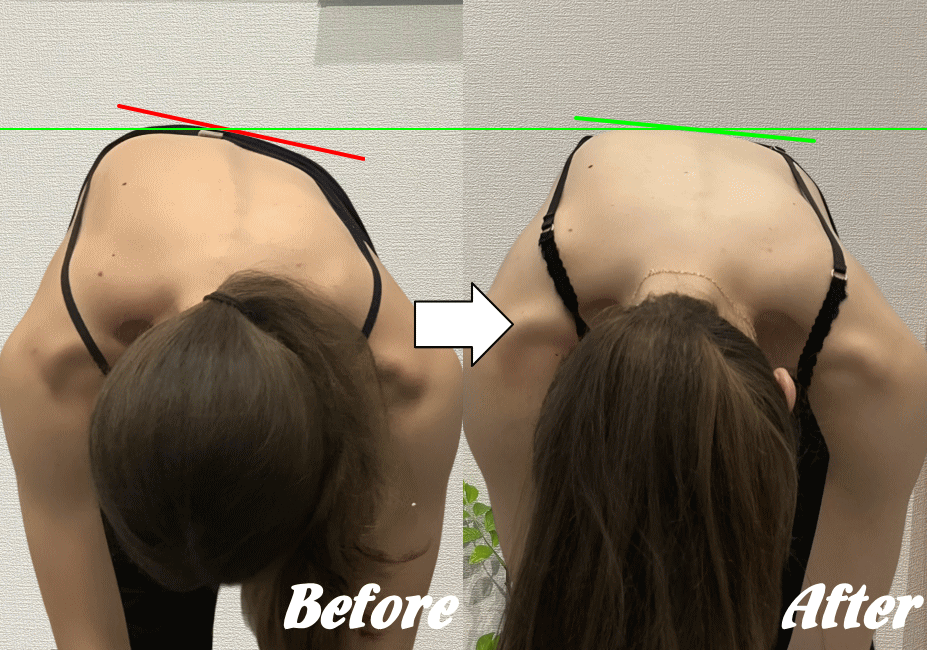 側弯施術のビフォー&アフター1