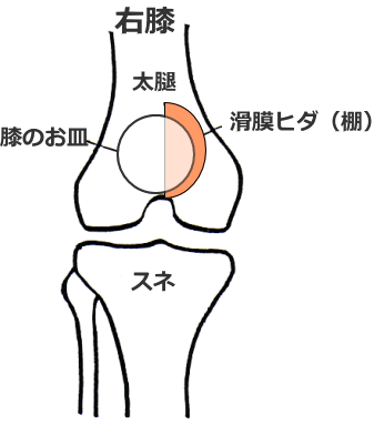 タナ障害のヒダ