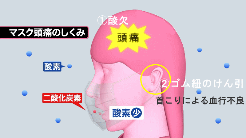 マスク頭痛の原因
