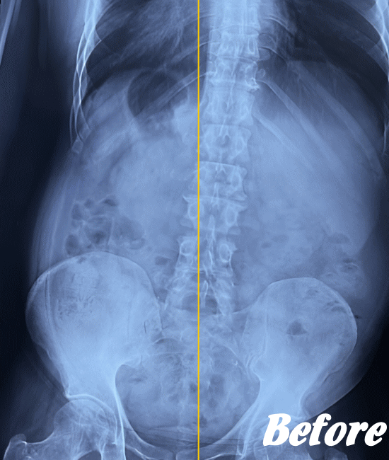 施術前の腰のX-ray画像