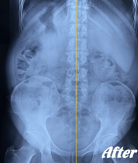 施術後の腰のX-ray画像