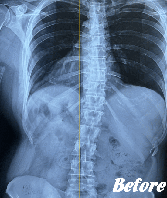 腰痛のX-ray画像