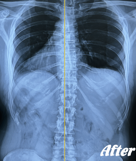 正常のX-ray画像