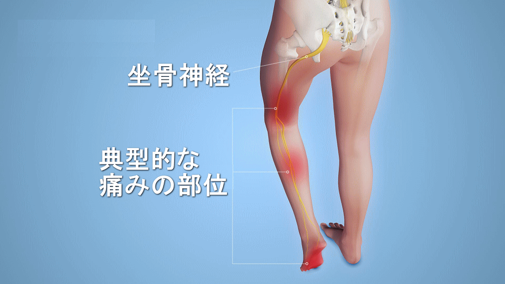 坐骨神経痛イメージ