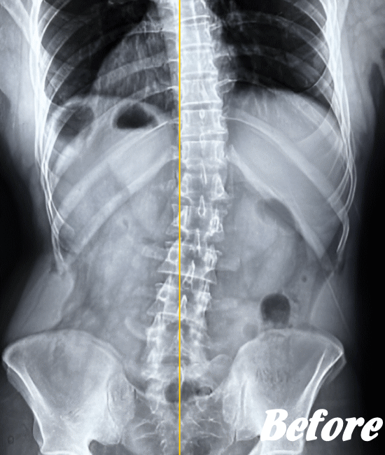 施術前の骨盤と腰椎