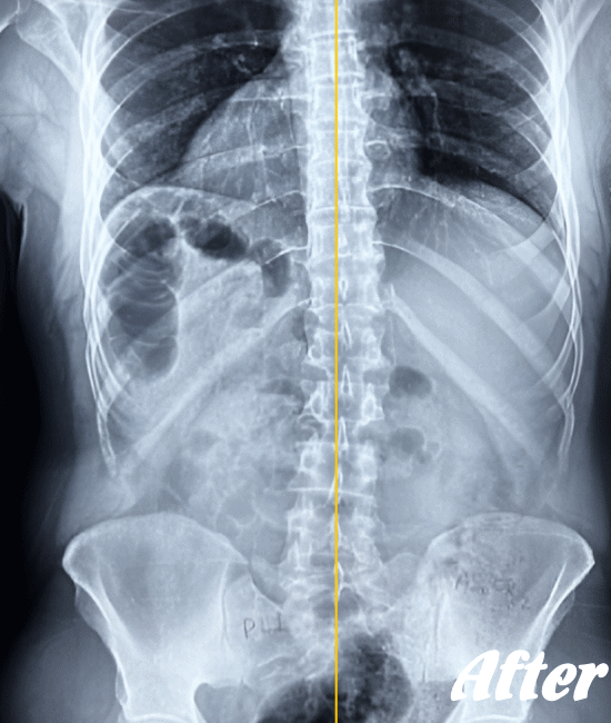 施術後の骨盤と腰椎