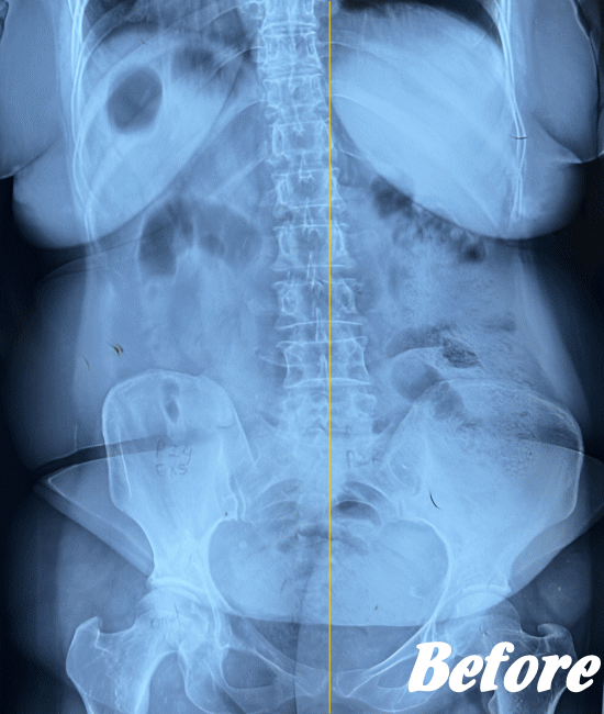 施術前の骨盤と腰椎