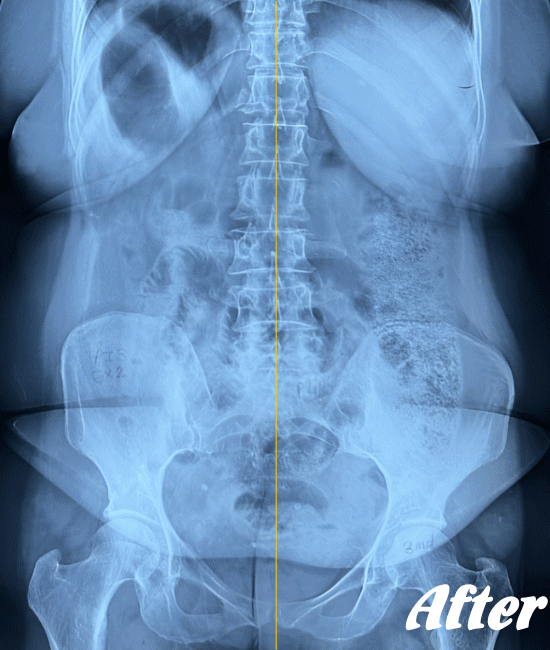 施術後の骨盤と腰椎