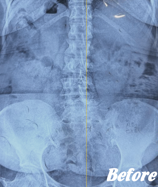 施術前の骨盤と腰椎