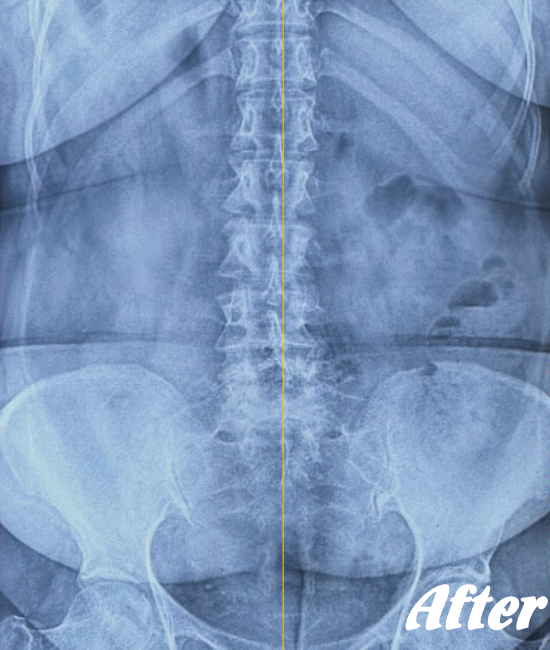 施術後の骨盤と腰椎