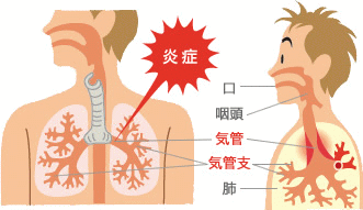 咳が止まらない気管支喘息